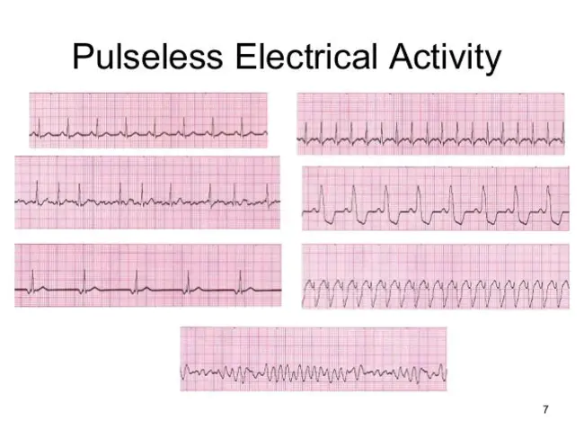 Pulseless Electrical Activity (cardiac) : 无脉冲电活动（心脏）