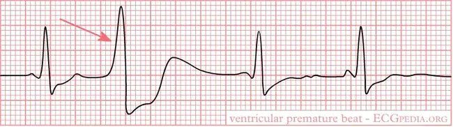 Premature Junctional Tachycardia : 过早交界性心动过速