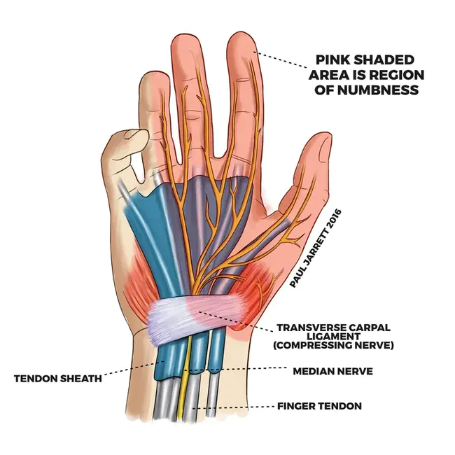 Carpal Tunnel Syndrome : 腕管综合症