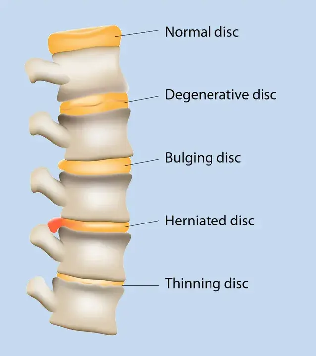 Degenerative Disc Disease : 退行性椎间盘病