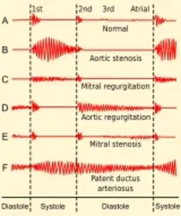 Diastolic Murmur : 舒张性杂音