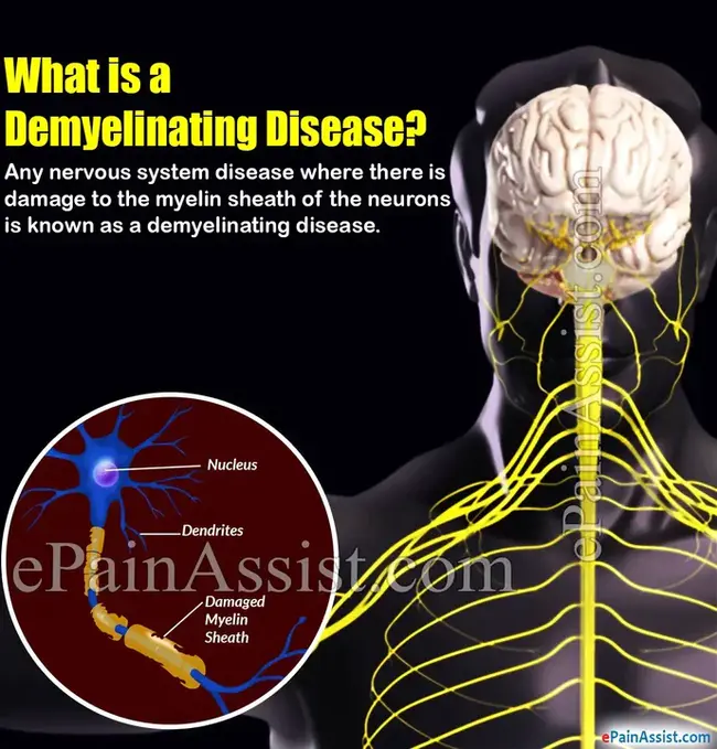 Demyelinating Optic Neuritis : 脱髓鞘性视神经炎