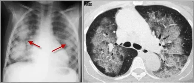 Diffuse Pulmonary Disease : 弥漫性肺疾病