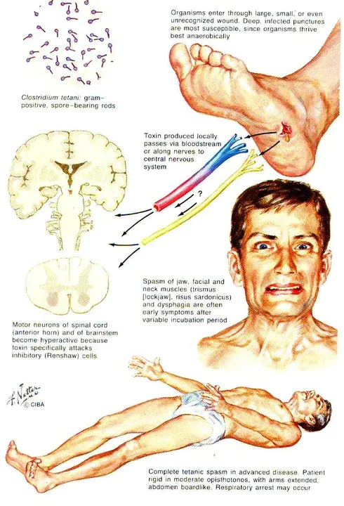 Tetanus booster with Diphtheria booster : 破伤风助推器加白喉助推器