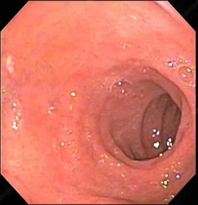 Duodenal Ulcer : 十二指肠溃疡