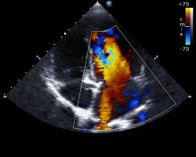 Echocardiogram : 超声心动图