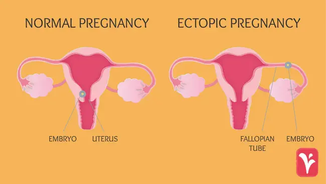 Ectopic pregnancy : 异位妊娠