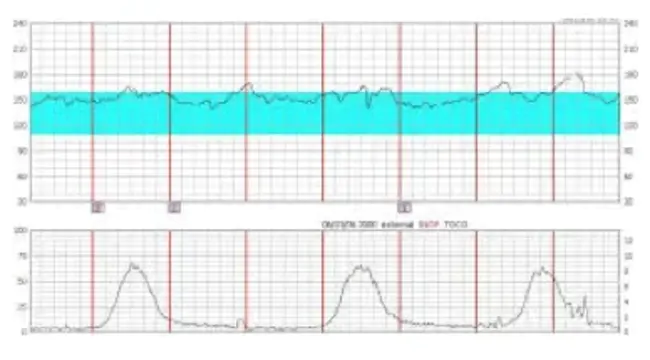 Fetal Heart Rate : 胎儿心率