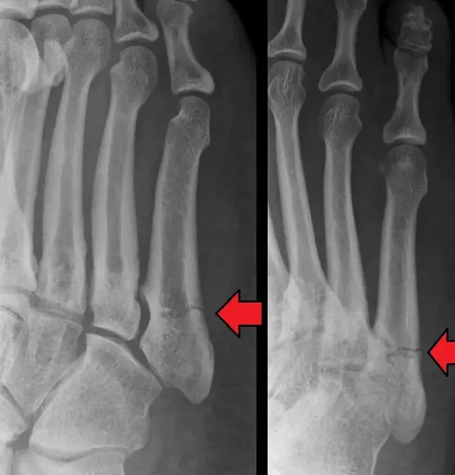 Fracture, Simple Comminuted : 单纯粉碎性骨折