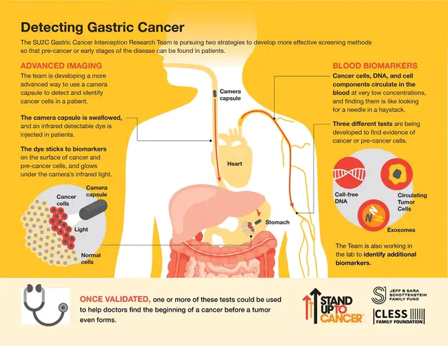 Gastric Resection : 胃切除术