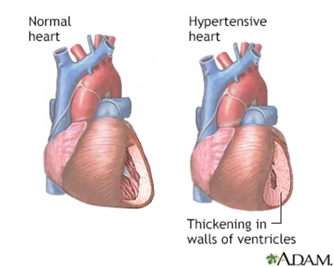 Hypertensive cardiovascular disease : 高血压心血管病