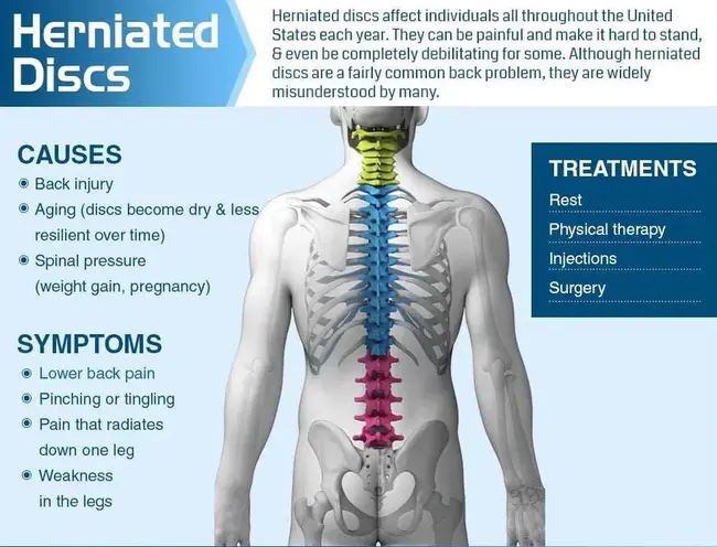 Herniated disc syndrome : 椎间盘突出综合征