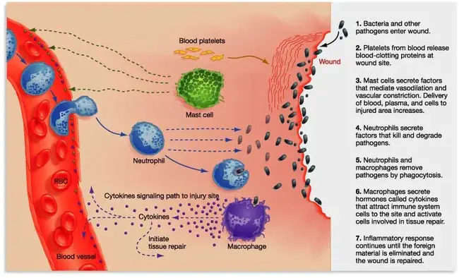 Inflammatory Bowel Disease : 炎症性肠病