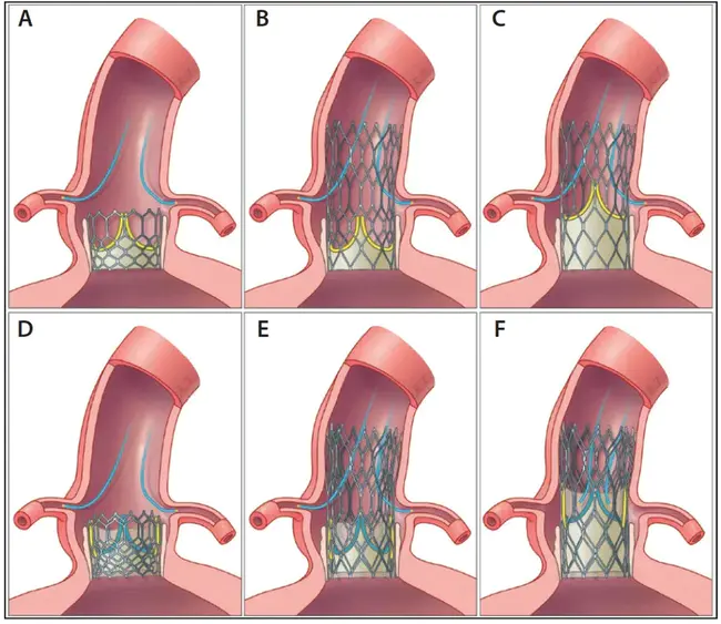 Intra- Peritoneal : 腹腔内