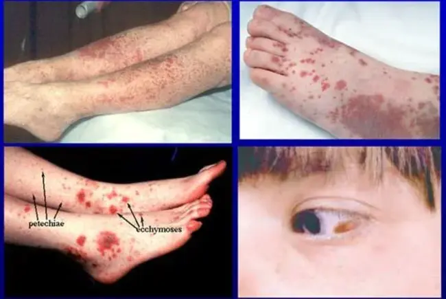 Idiopathic Thrombocytopenic Purpura : 特发性血小板减少性紫癜