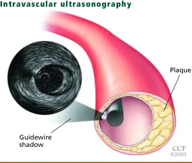 Intravascular : 血管内的