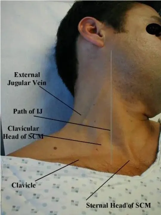 Jugular-Venous Distension : 颈静脉扩张