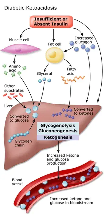 Ketoacidosis : 酮酸中毒