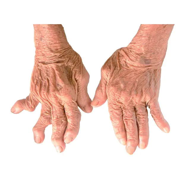 Rheumatoid Arthritis : 类风湿关节炎