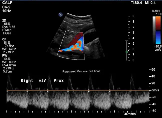 Right Iliac Crest : 右侧髂嵴