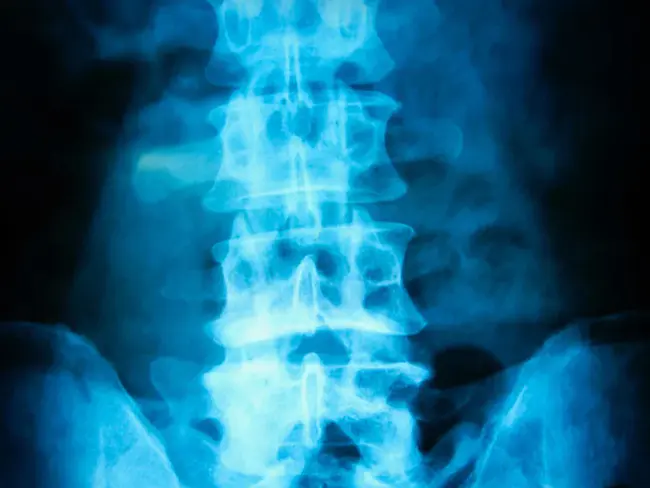 Ruptured Intervertebral Disc : 椎间盘破裂