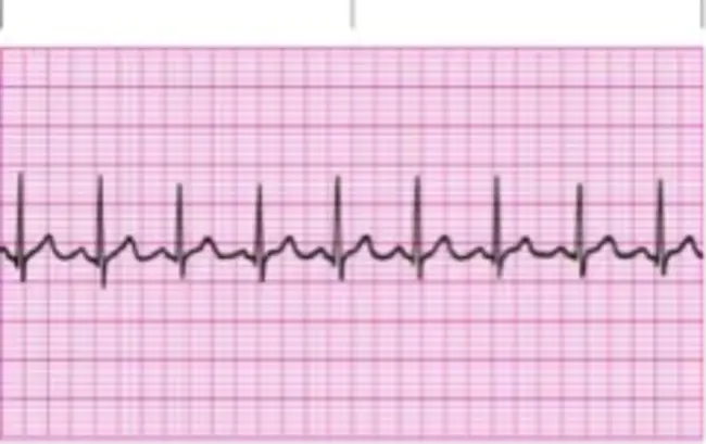 Regular sinus rhythm : 规则窦性心律