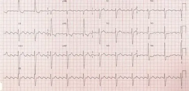 Rapid Ventricular Response : 快速心室反应