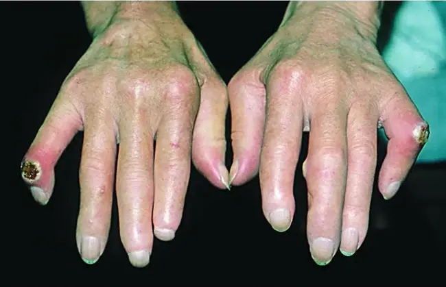 Scleroderma : 硬皮病