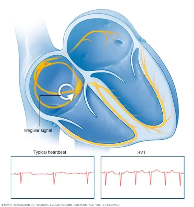 SupraVentricular Tachycardia : 室上性心动过速