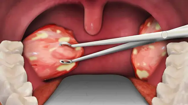 Tonsillectomy And Adenoidectomy : 扁桃体切除术和腺样体切除术