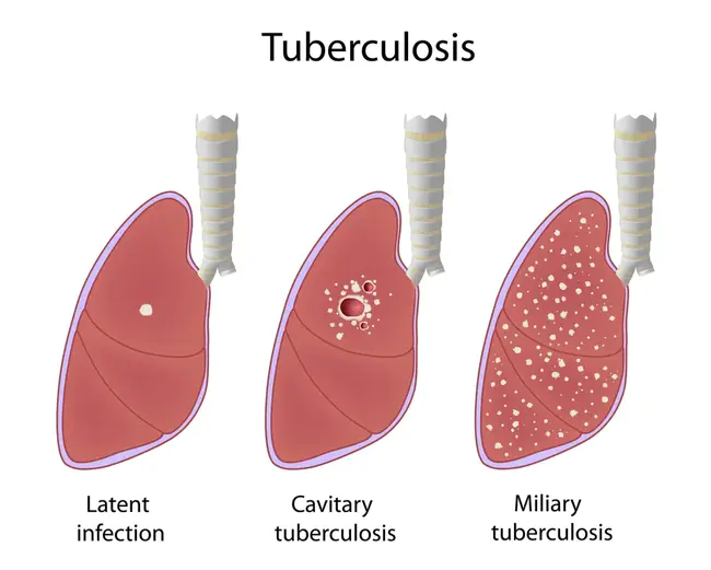 Tuberculosis : 结核病