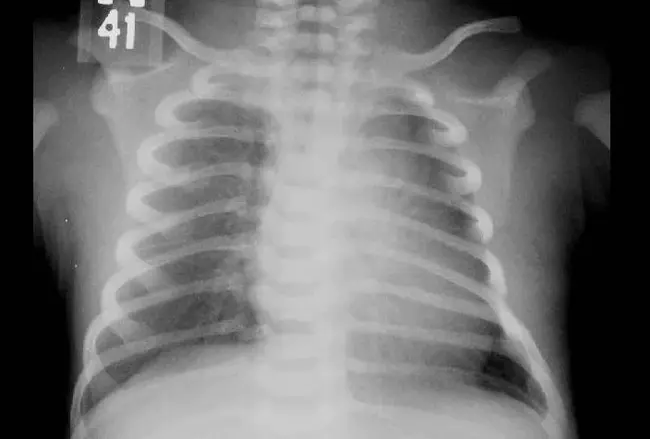 Transient Cerebral Ischemia : 短暂性脑缺血