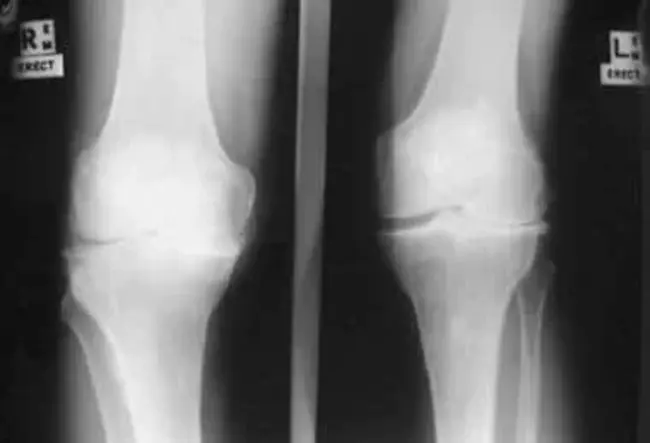 Total Knee Arthroplasty : 全膝关节置换术