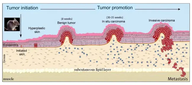 Tumor, Nodes, Metastases : 肿瘤，结节，转移