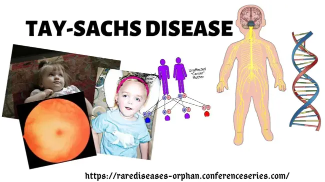 Tay-Sachs Disease : 泰萨克斯病