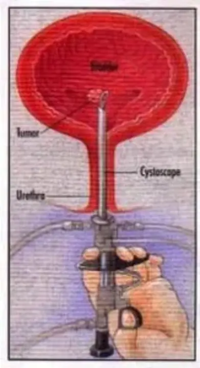 Transurethral resection : 经尿道电切术