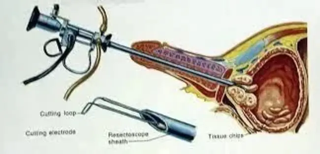 Trans-Urethral Resection of the Prostate : 经尿道前列腺切除术