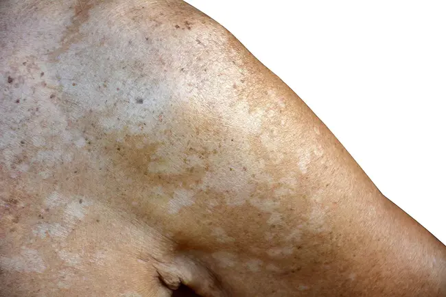 Tinea Versicolor : 花斑癣