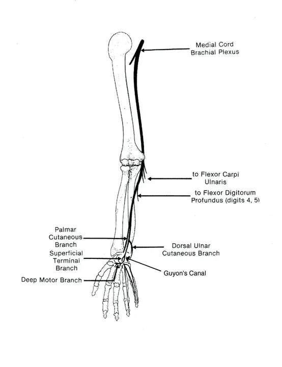 Ulnar Deviation : 尺偏