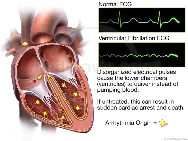 Ventricular Fibrillation : 心室颤动