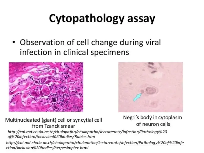 Viral infection : 病毒感染