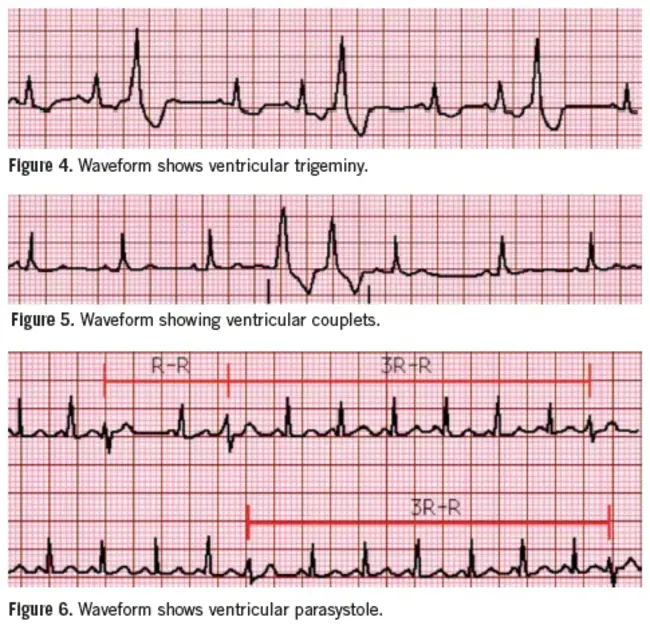 Ventricular Premature Beat : 室性早搏