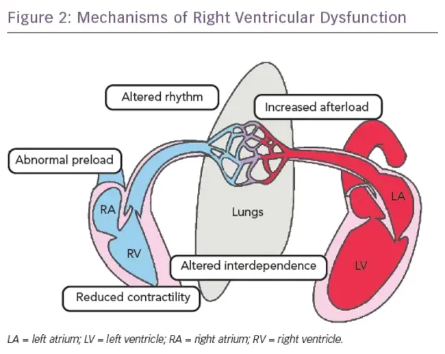 Ventricular Premature Contraction : 室性早搏