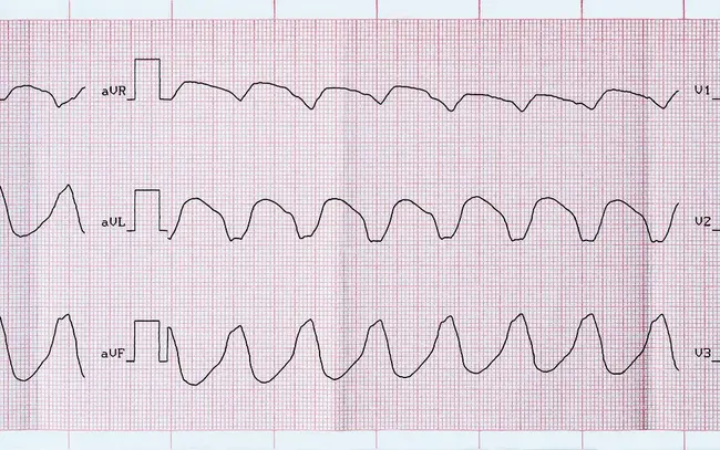 Ventricular Septal Defect : 室间隔缺损