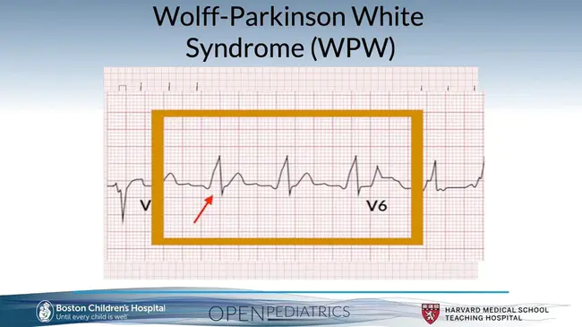 Wolff- Parkinson- White Syndrome : 沃尔夫-帕金森-怀特综合征