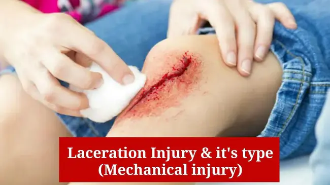 Laceration : 撕裂伤