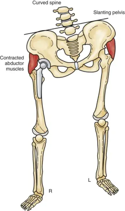 Leg Length Discrepancy : 腿长差异