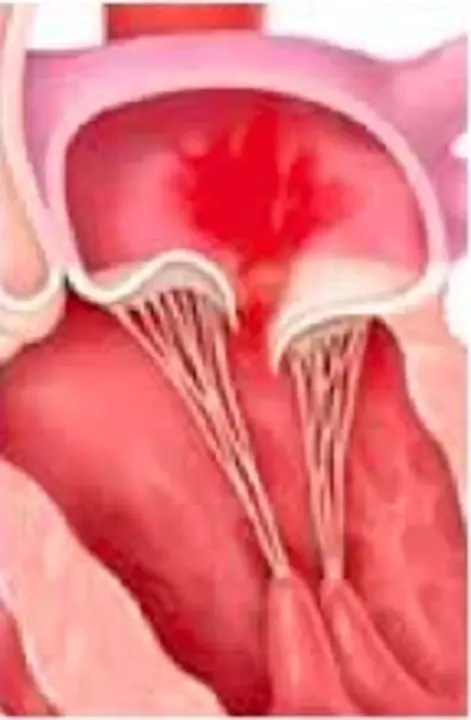 Mitral Insufficiency : 二尖瓣关闭不全