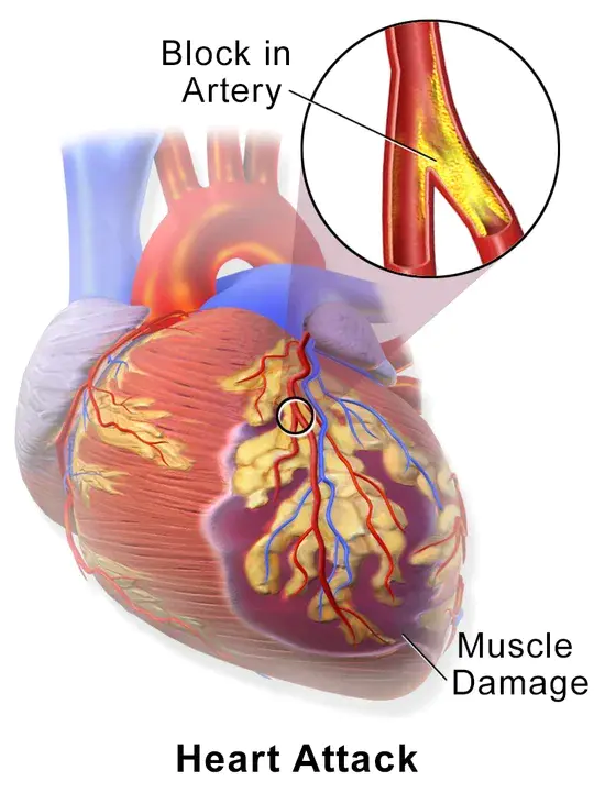 Myocardial Infarction : 心肌梗塞