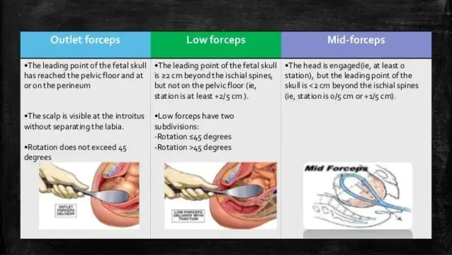 MidForceps Delivery : 中钳分娩